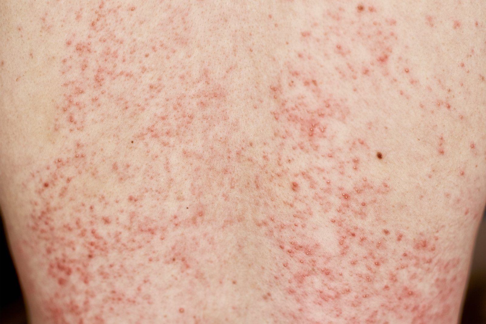 Allergisk utslett på huden. Kvinne med dermatologisk problem på rygghuden