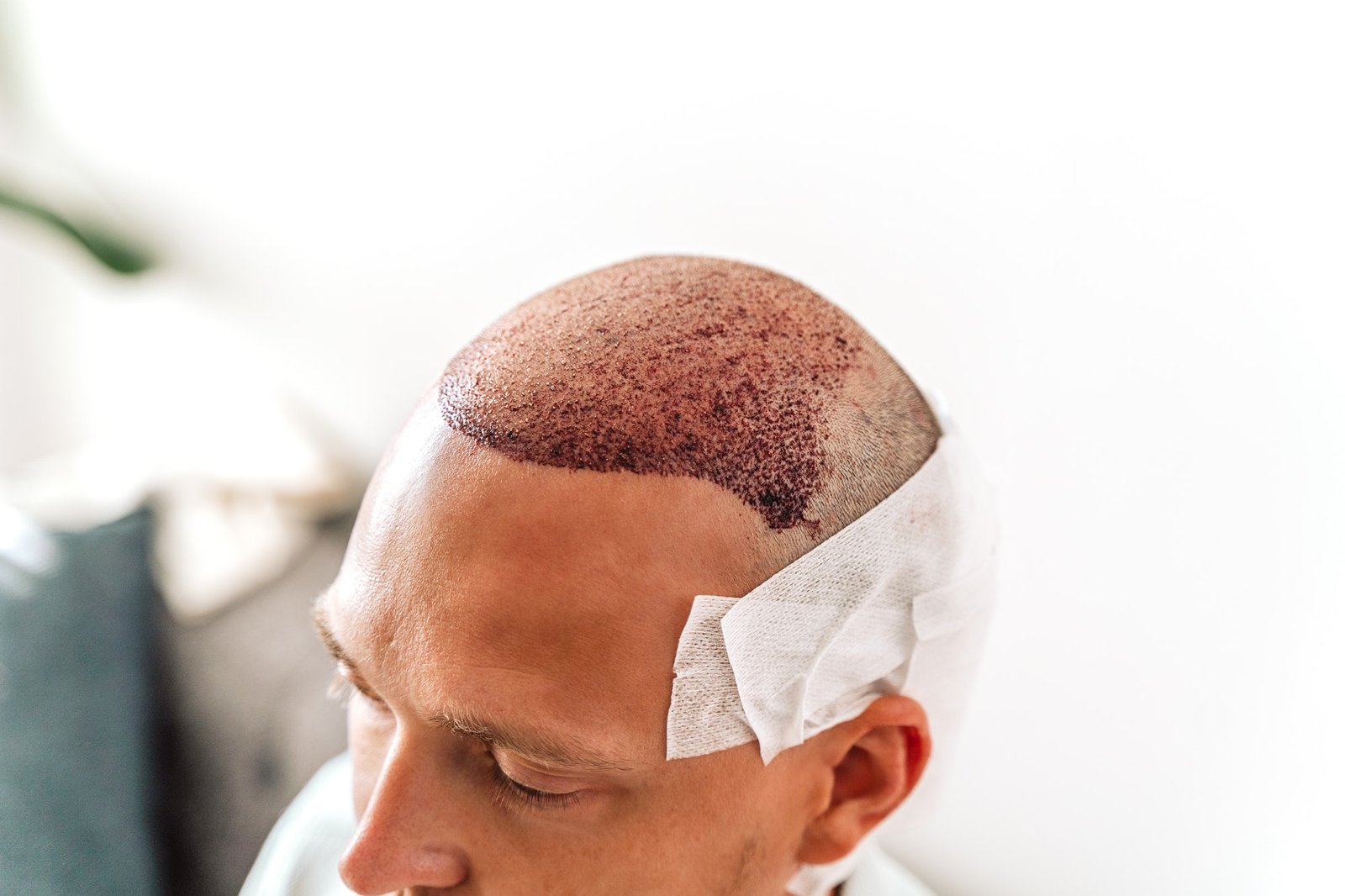 hårtransplantasjon er en av de mest vanlige metodenen for å kjempe mot hårtap