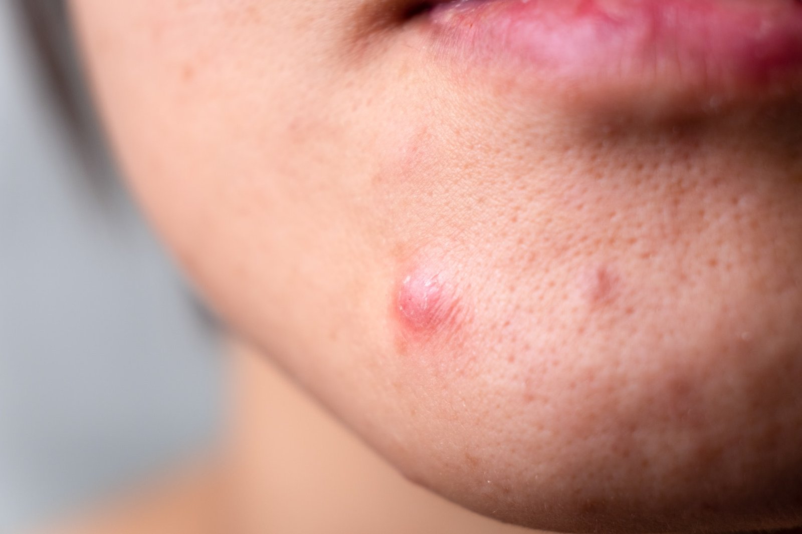 Akne kan oppstå hvis vaselin tetter porene i huden